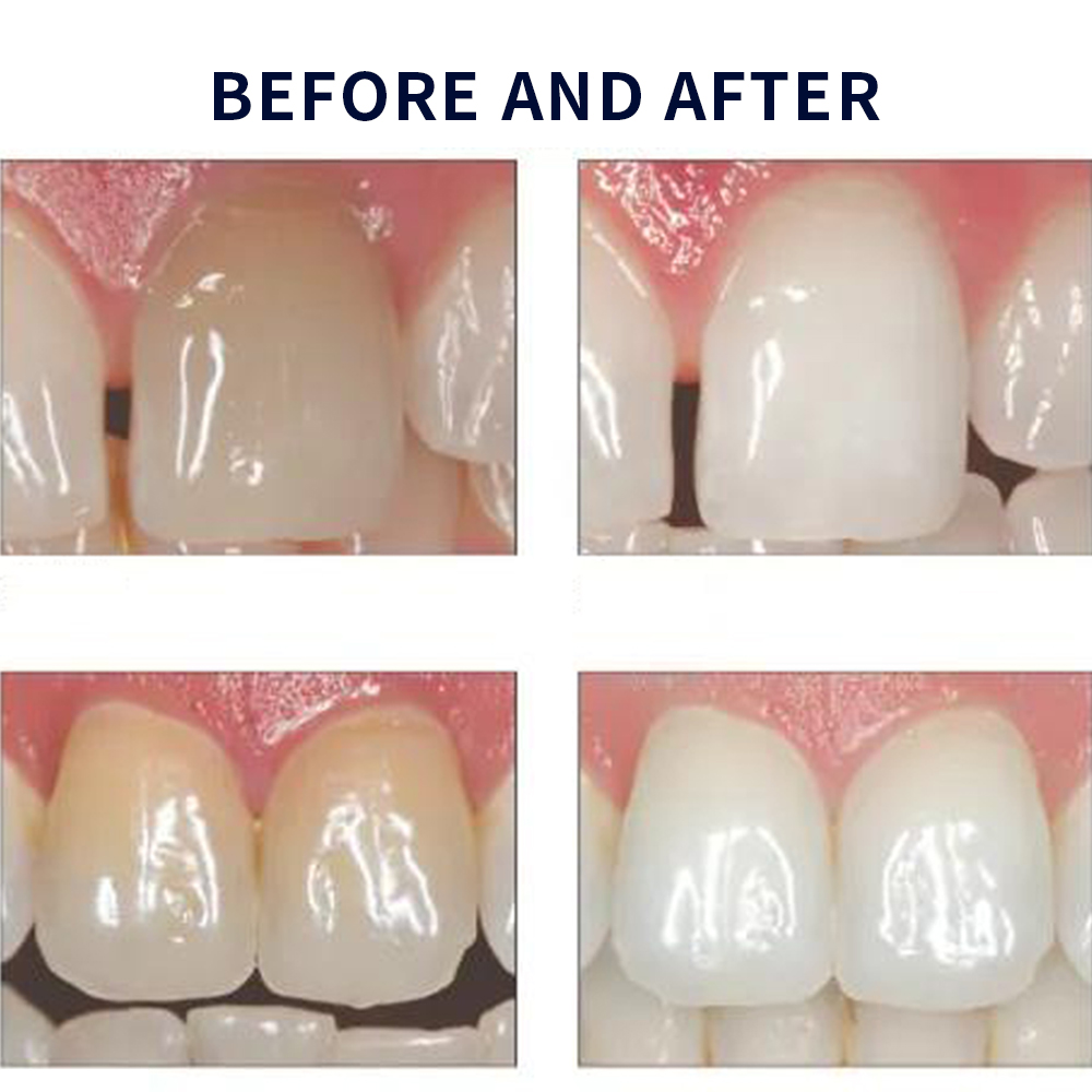 Opalescentie Whitening 20% Pf  - Teeth Whitening Singapore recensie en prijs