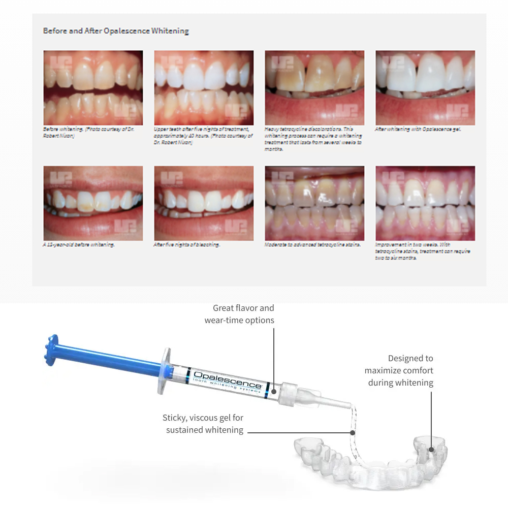 Opalescentie Whitening 20% Pf  - Teeth Whitening Singapore recensie en prijs