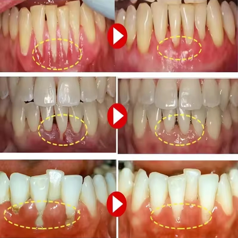 Tandenbleekgel Tandvleesrepara - Teeth Whitening Gel recensie en prijs