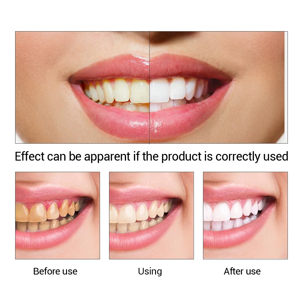 Fteenply Tanden Whitening Esse - Teeth Whitening Singapore recensie en prijs