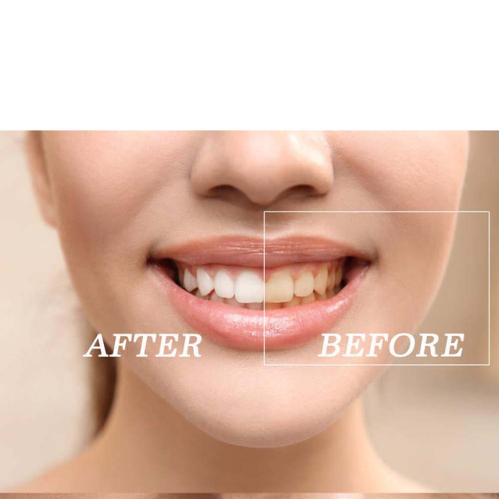 Topkwaliteit Peroxide Tanden W - Teeth Whitening Gel recensie en prijs